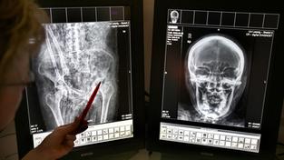 Blick auf digitale Röntgenaufnahmen (Foto: picture-alliance/ dpa | Waltraud Grubitzsch)